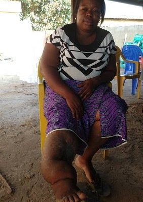 Nana Djoua : Chronique d’une vie détruite avec une maladie inconnue